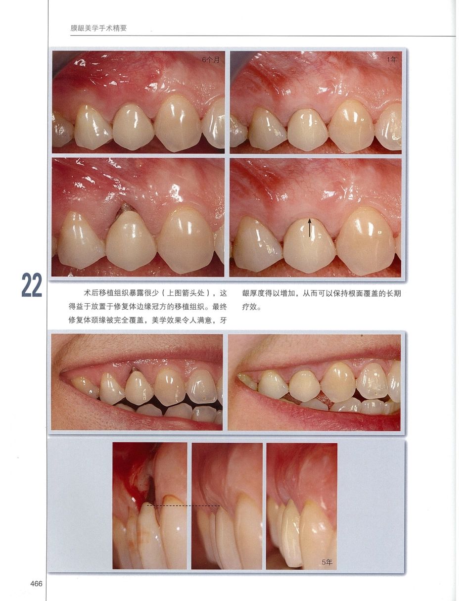 184膜龈美学手术精要_481-500.pdf_第3页