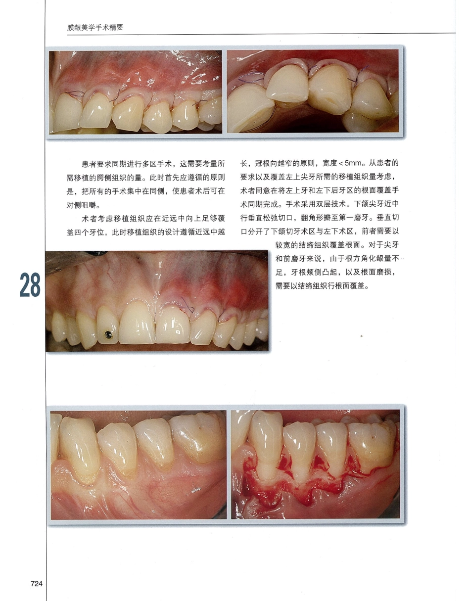 184膜龈美学手术精要_741-760.pdf_第1页