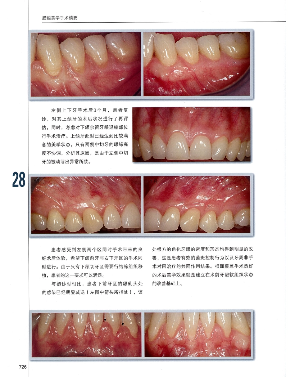 184膜龈美学手术精要_741-760.pdf_第3页