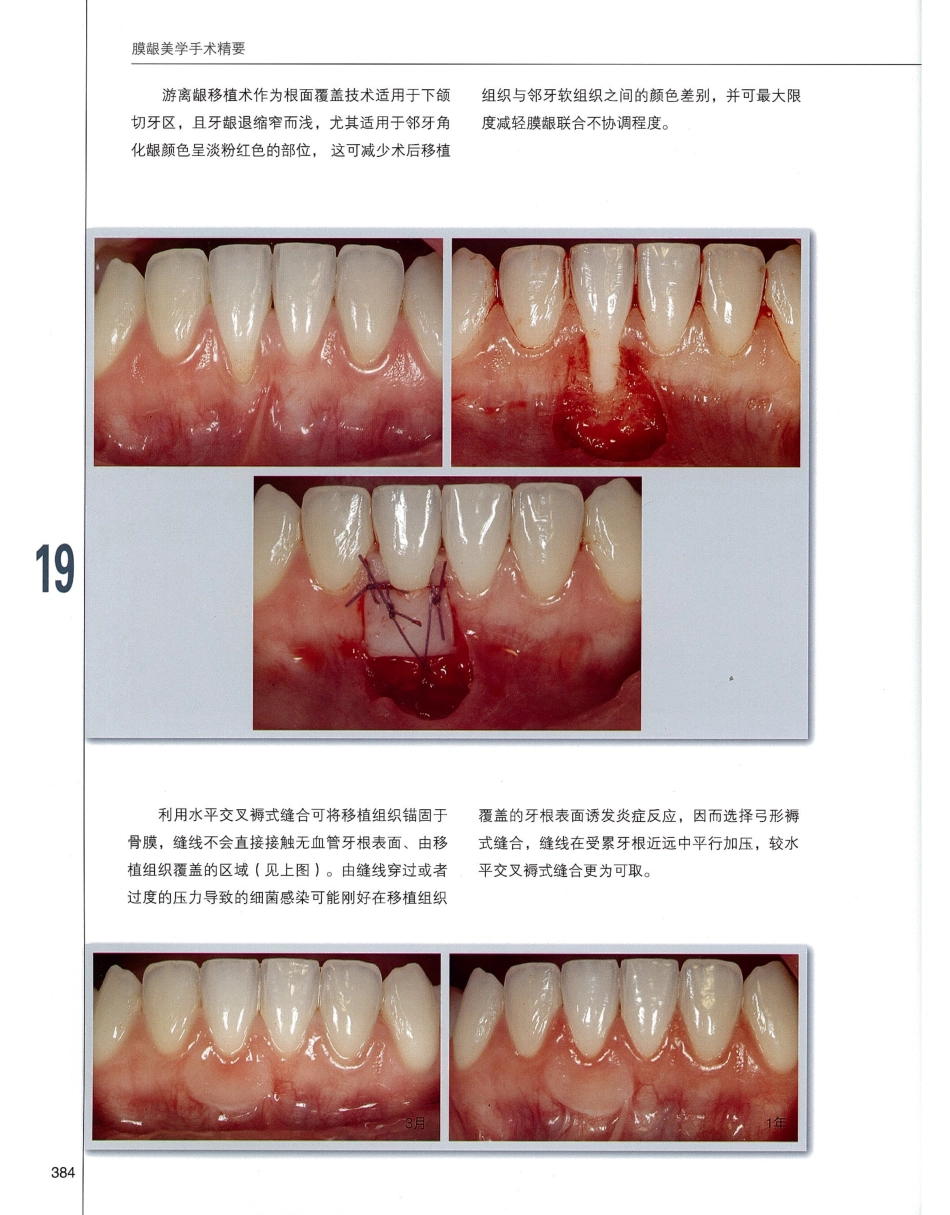 184膜龈美学手术精要_401-420.pdf_第1页