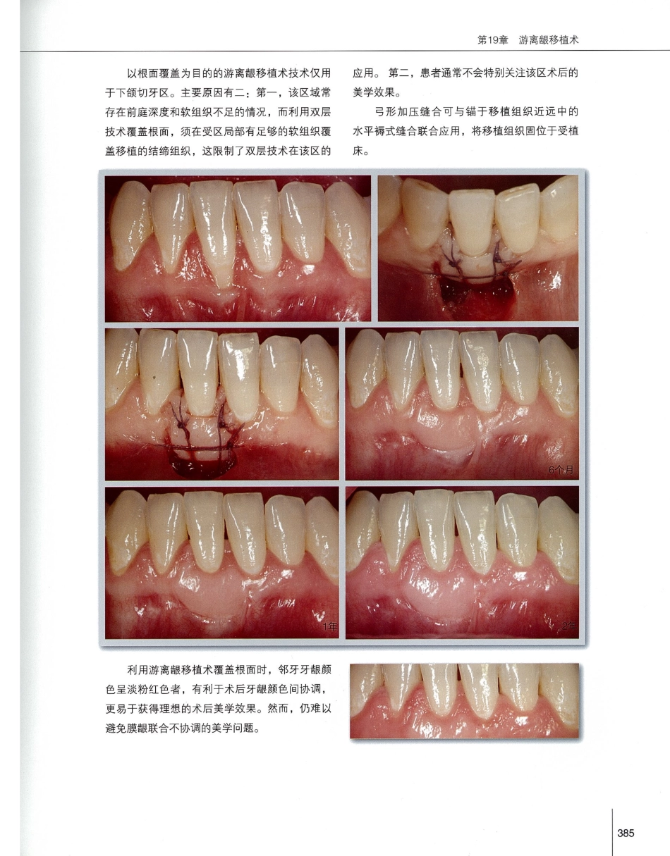 184膜龈美学手术精要_401-420.pdf_第2页
