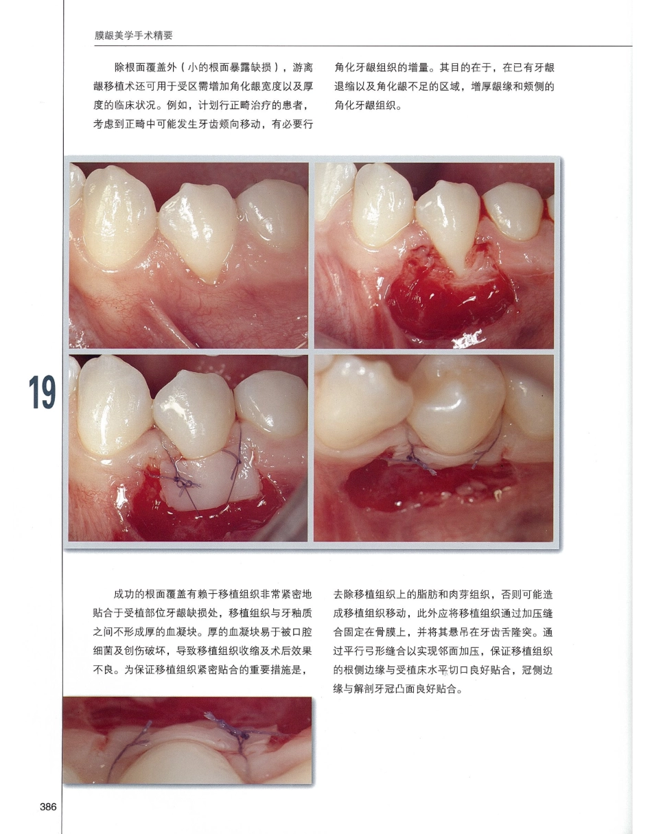 184膜龈美学手术精要_401-420.pdf_第3页