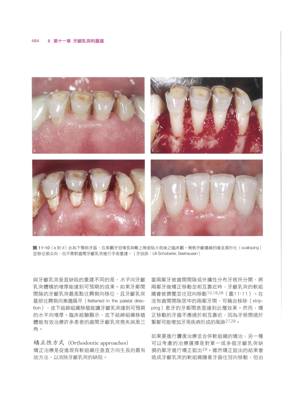 179.牙周整形美容与种植手术_497-504.pdf_第2页