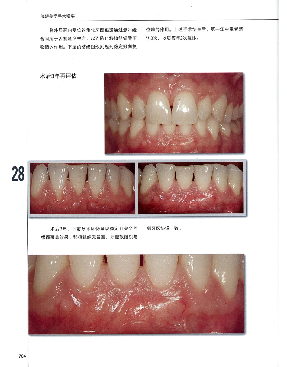 184膜龈美学手术精要_721-740.pdf_第1页