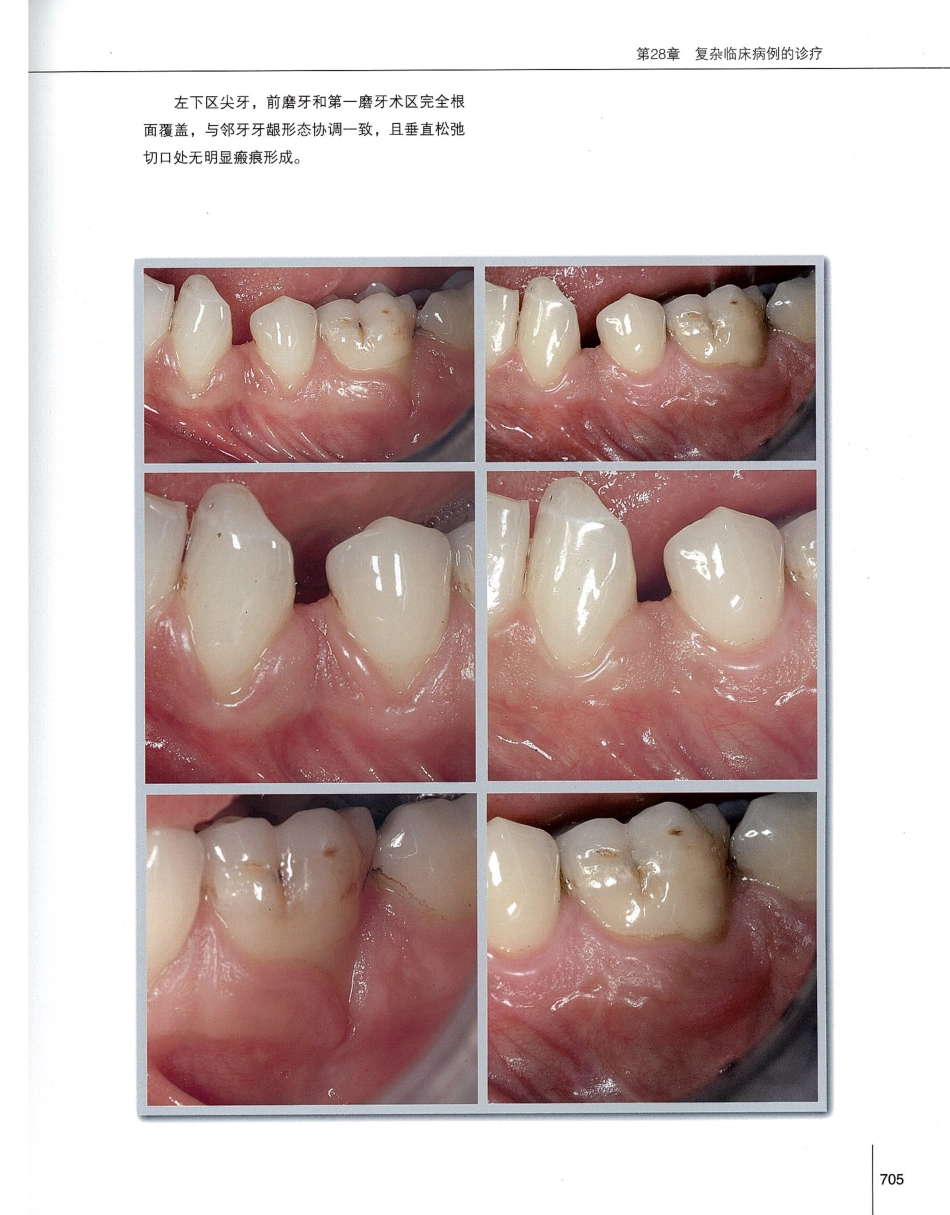 184膜龈美学手术精要_721-740.pdf_第2页