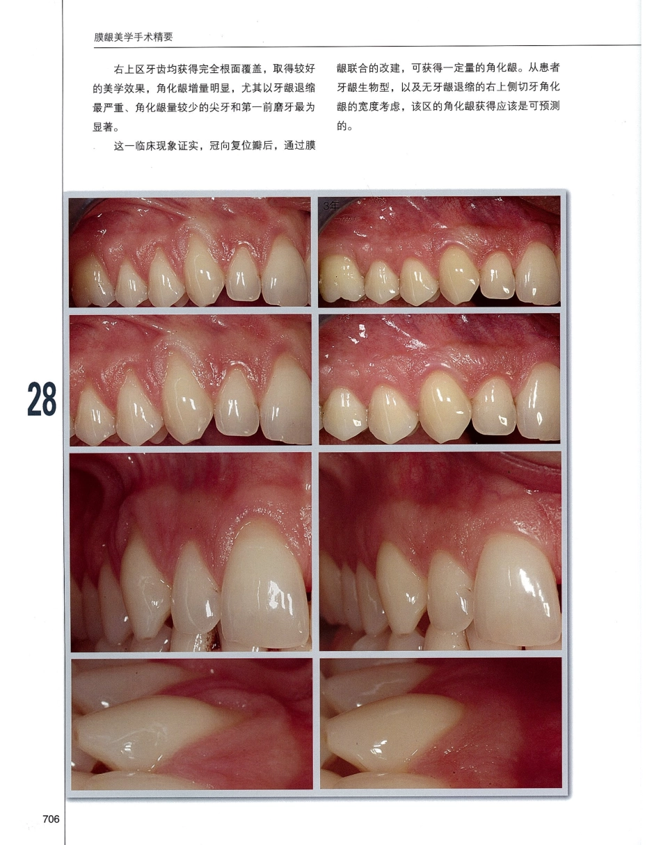 184膜龈美学手术精要_721-740.pdf_第3页