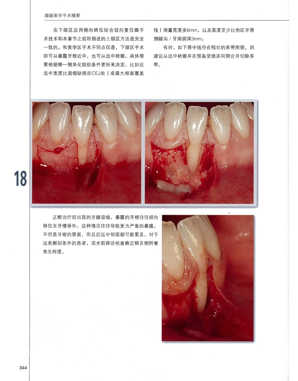 184膜龈美学手术精要_361-380.pdf_第1页