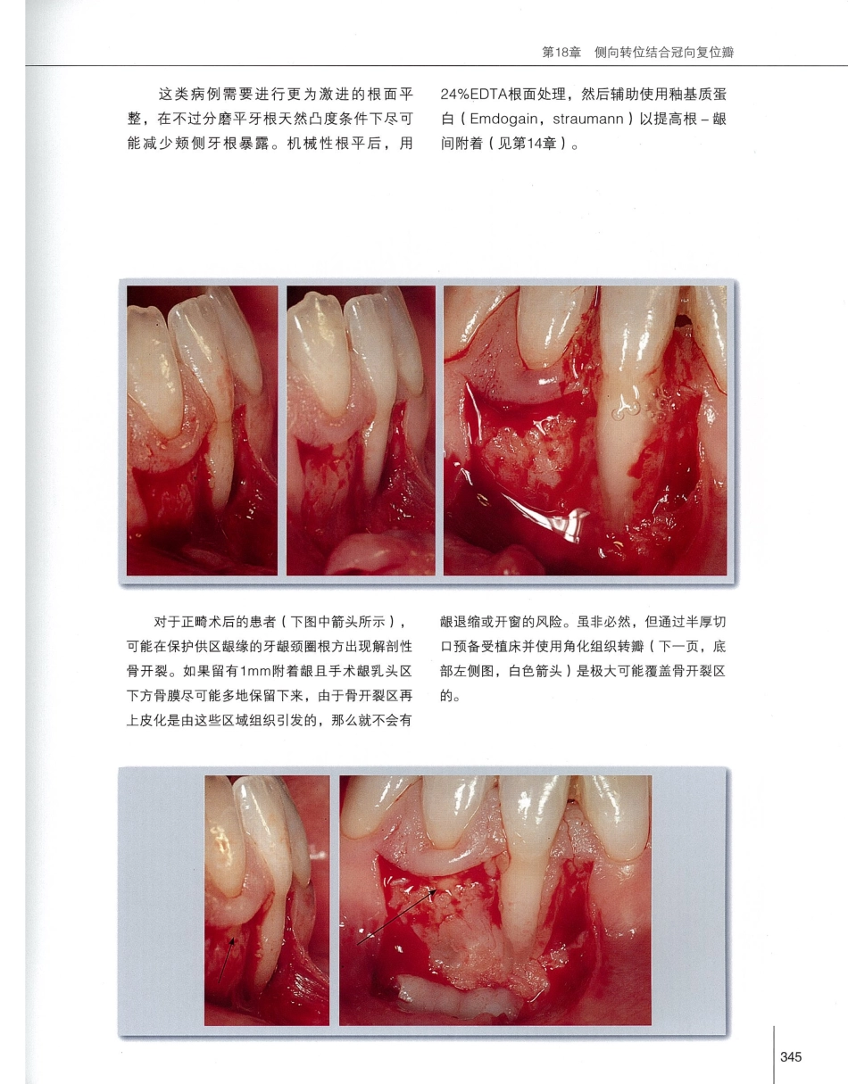 184膜龈美学手术精要_361-380.pdf_第2页