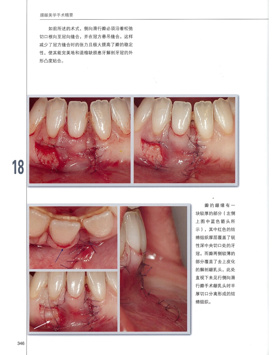 184膜龈美学手术精要_361-380.pdf_第3页