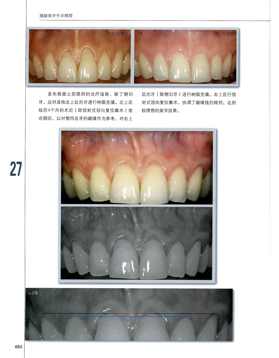 184膜龈美学手术精要_701-720.pdf_第1页