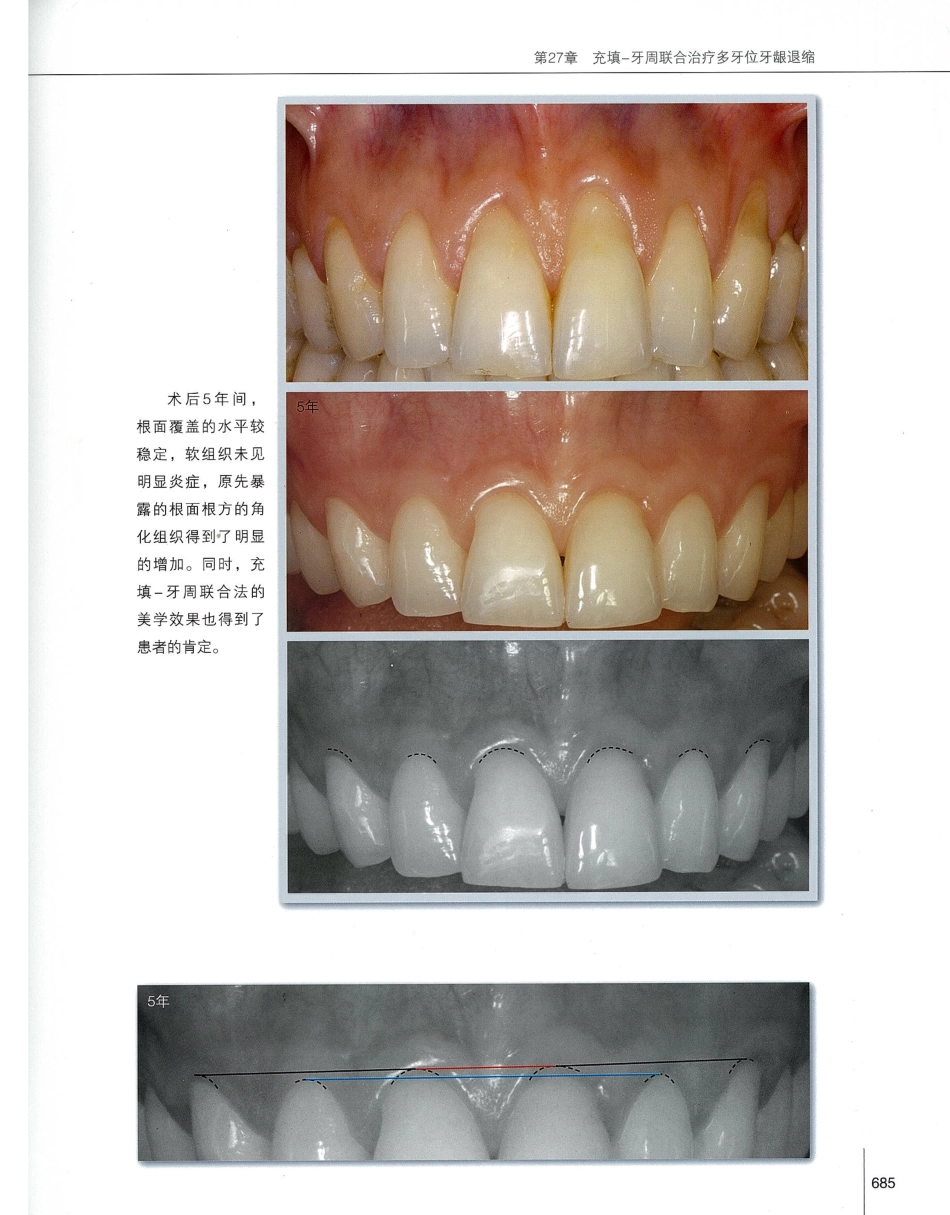 184膜龈美学手术精要_701-720.pdf_第2页