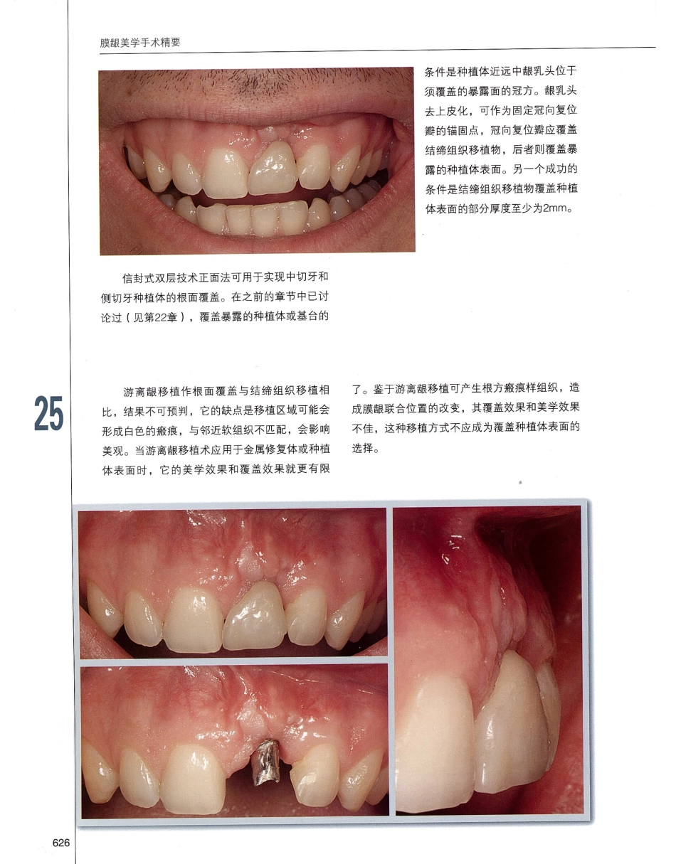 184膜龈美学手术精要_641-660.pdf_第3页