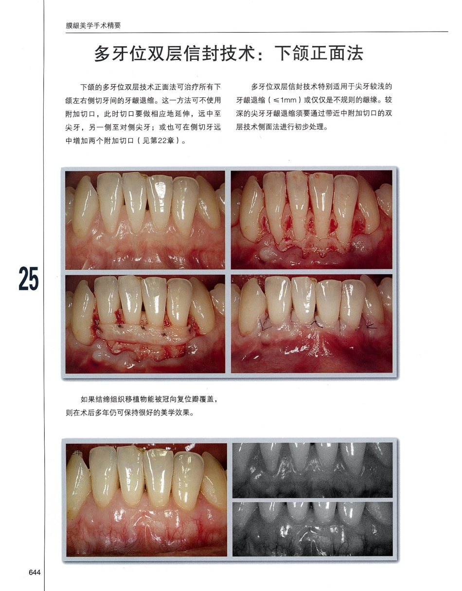 184膜龈美学手术精要_661-680.pdf_第1页