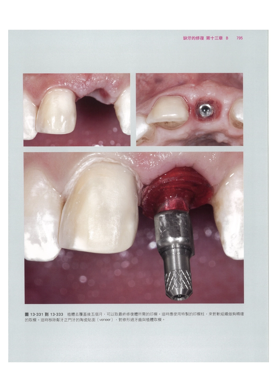 179.牙周整形美容与种植手术_809-816.pdf_第1页