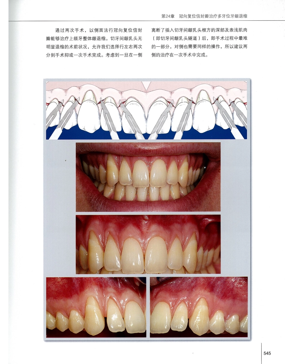 184膜龈美学手术精要_561-580.pdf_第2页