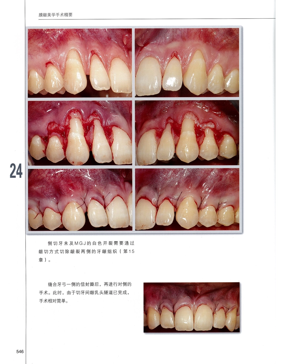 184膜龈美学手术精要_561-580.pdf_第3页