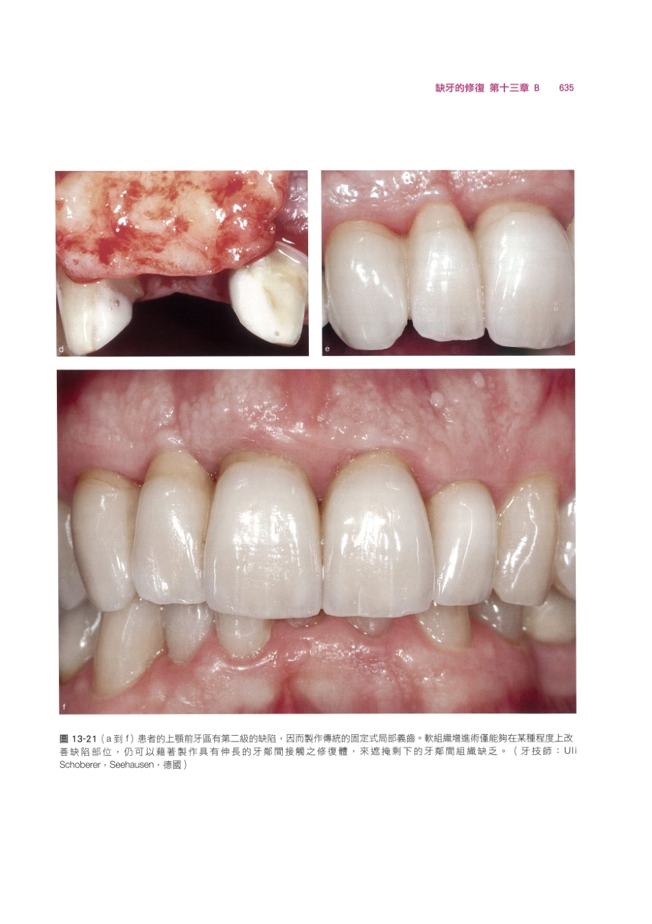 179.牙周整形美容与种植手术_649-656.pdf_第1页