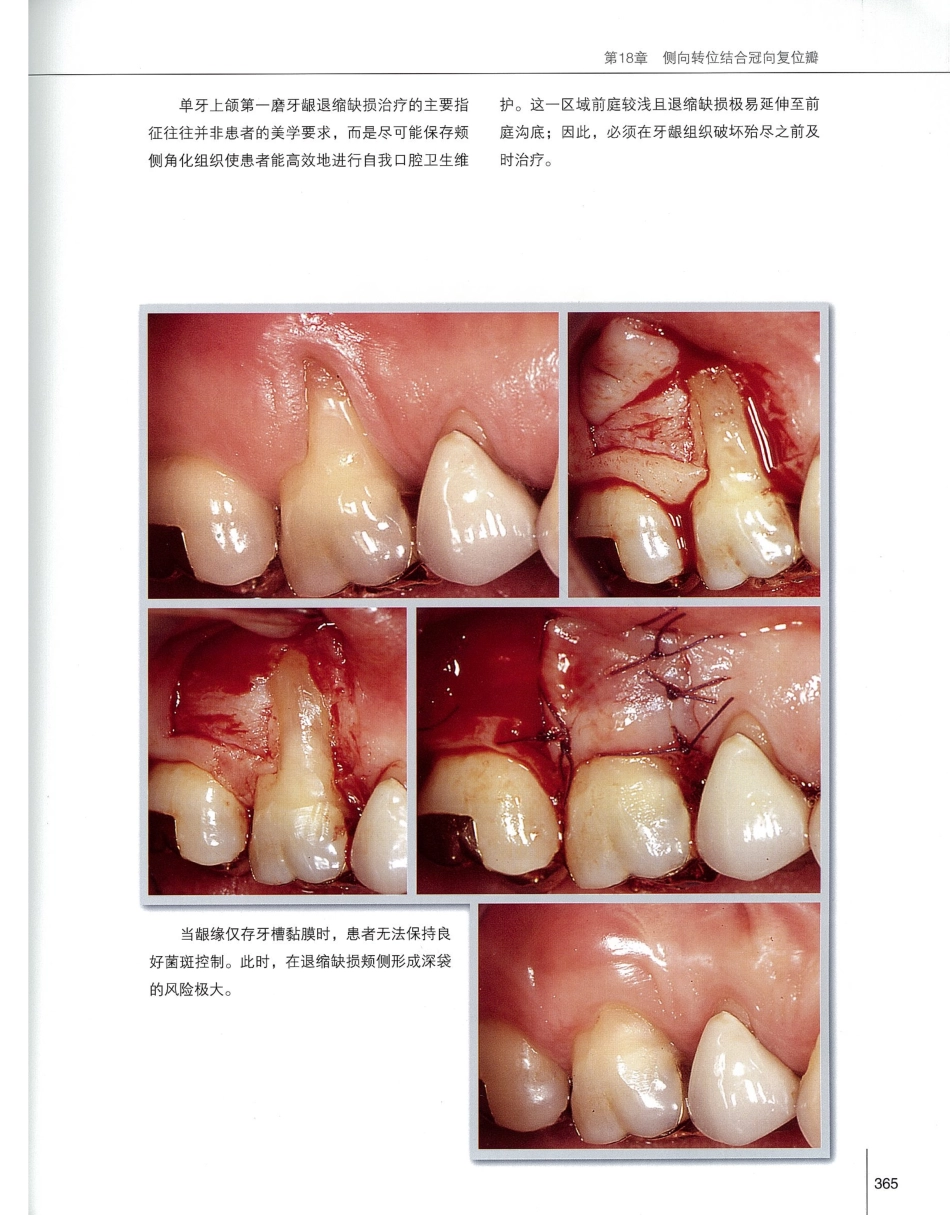 184膜龈美学手术精要_381-400.pdf_第2页