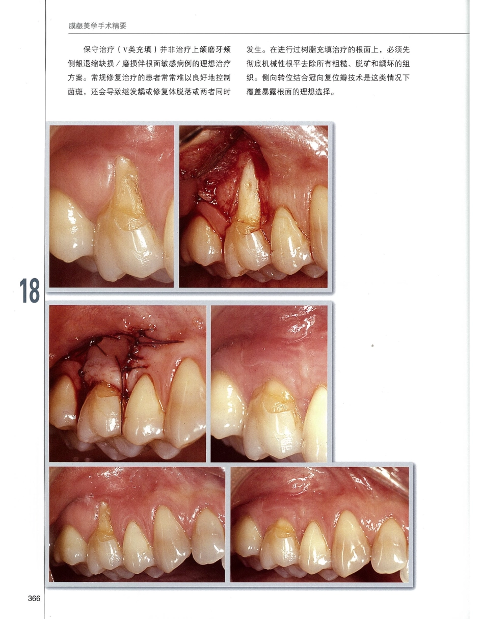 184膜龈美学手术精要_381-400.pdf_第3页