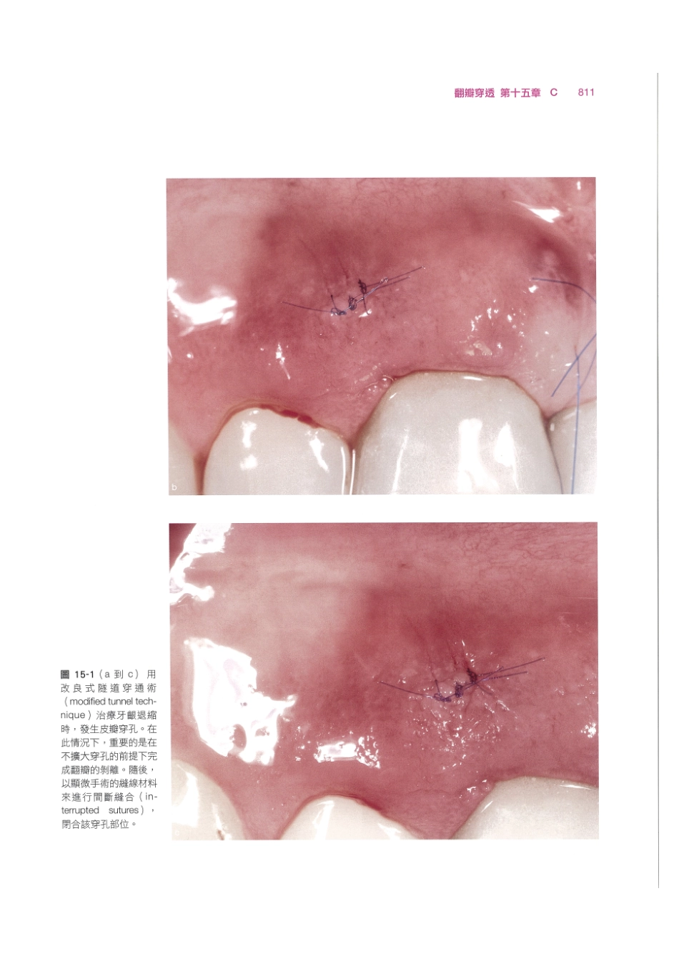 179.牙周整形美容与种植手术_825-832.pdf_第1页