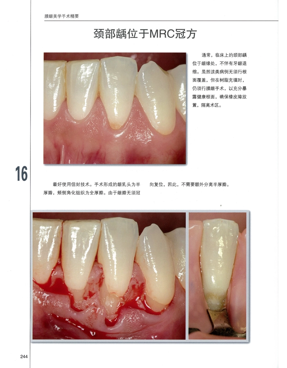 184膜龈美学手术精要_261-280.pdf_第1页