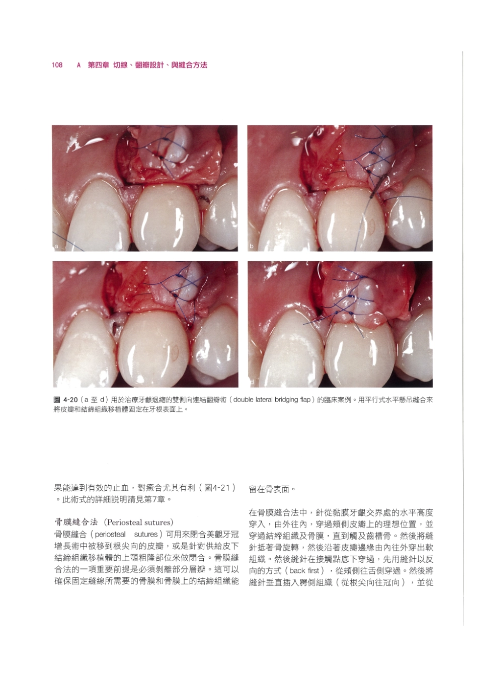 179.牙周整形美容与种植手术_121-128.pdf_第2页