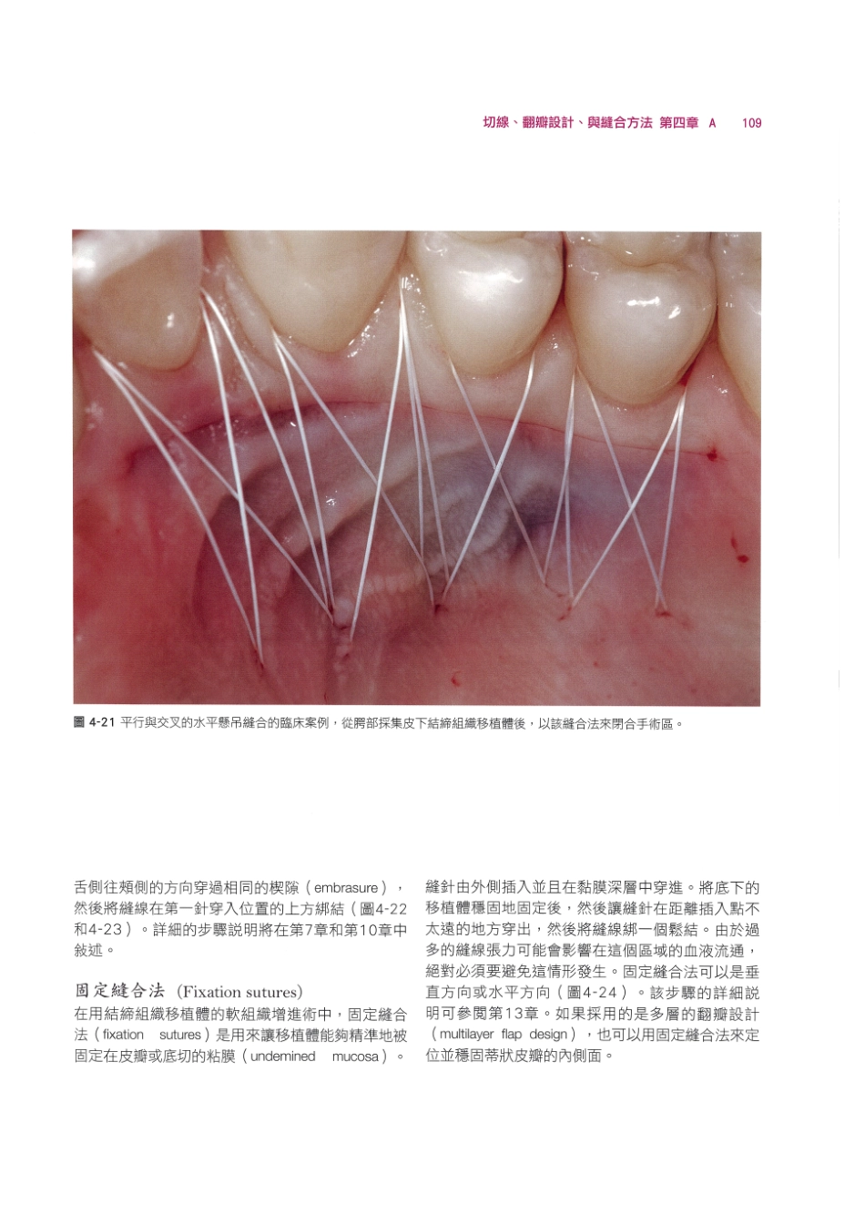 179.牙周整形美容与种植手术_121-128.pdf_第3页