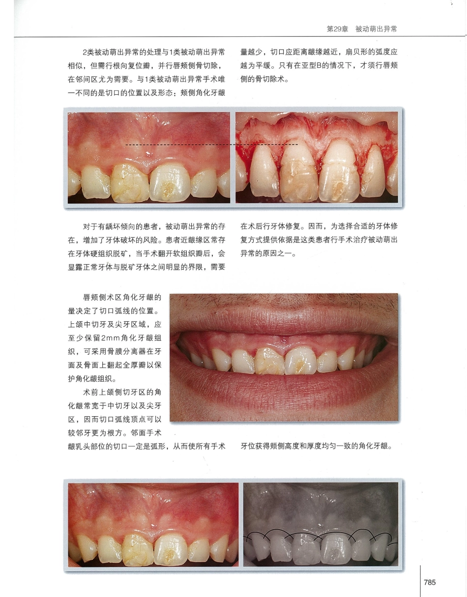 184膜龈美学手术精要_801-820.pdf_第2页