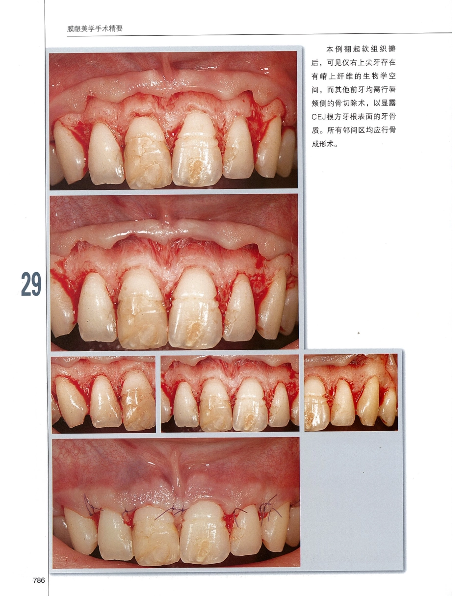184膜龈美学手术精要_801-820.pdf_第3页