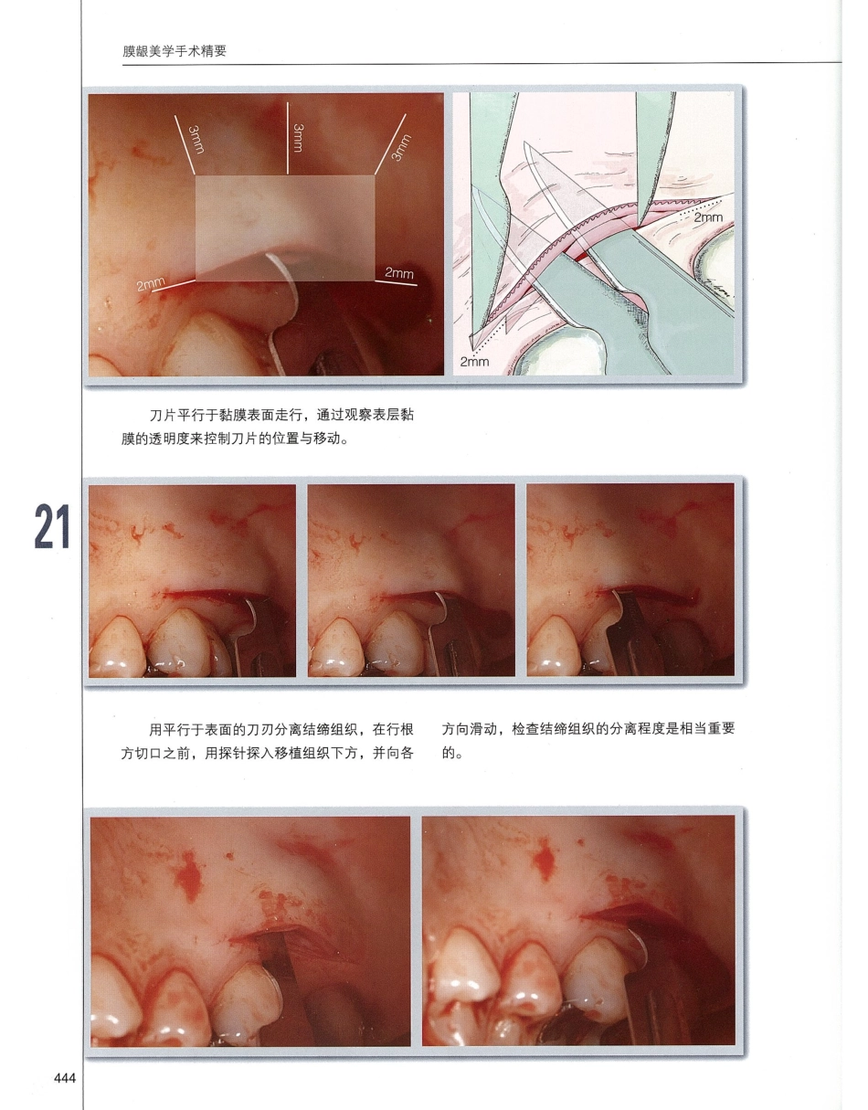 184膜龈美学手术精要_461-480.pdf_第1页