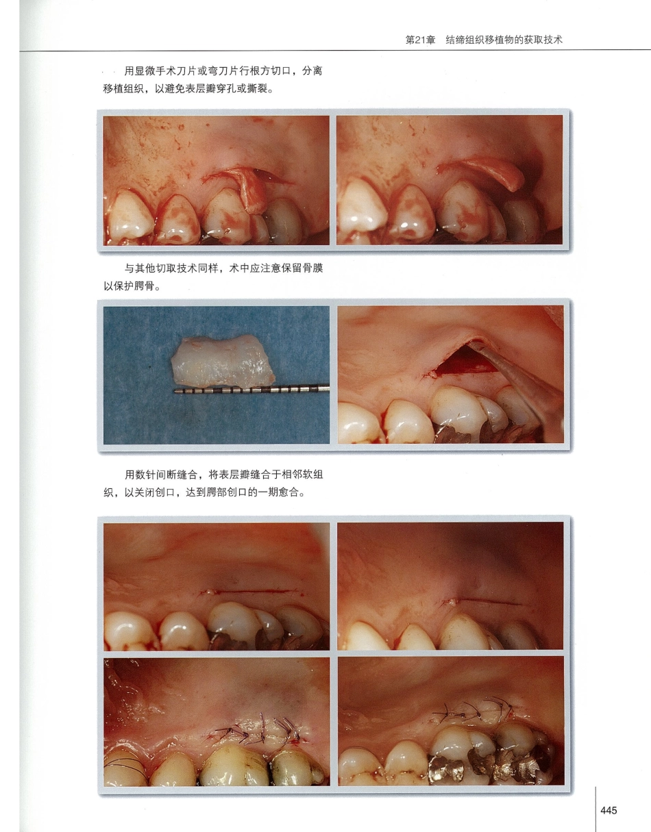 184膜龈美学手术精要_461-480.pdf_第2页