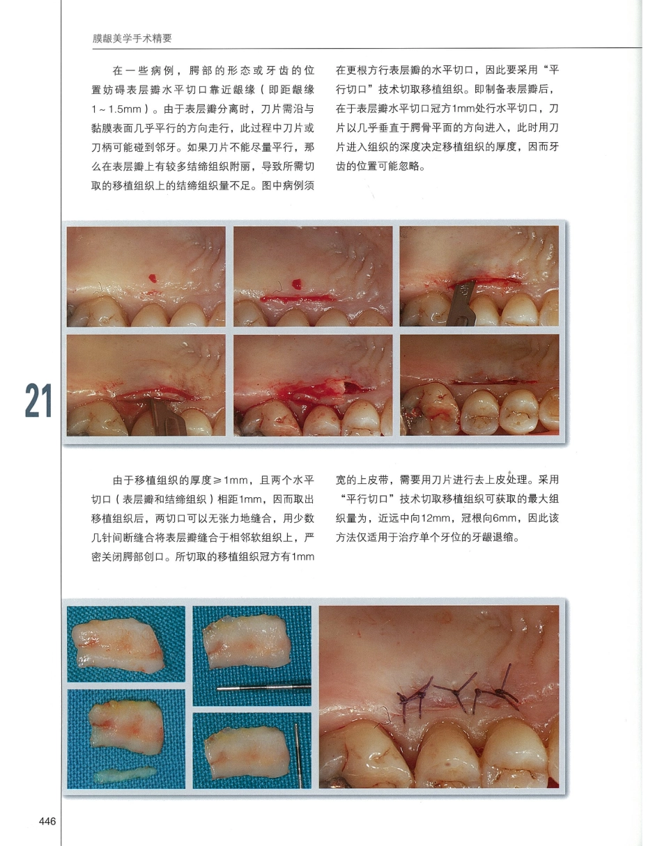 184膜龈美学手术精要_461-480.pdf_第3页