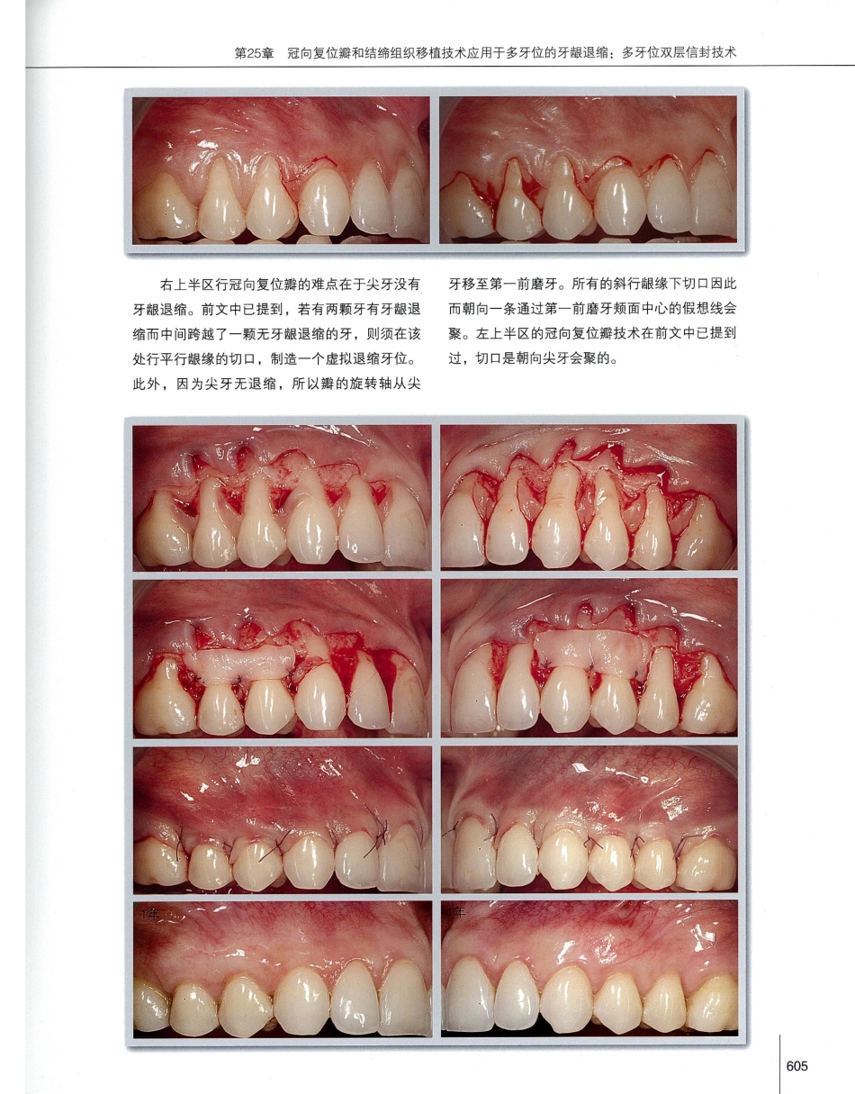184膜龈美学手术精要_621-640.pdf_第2页