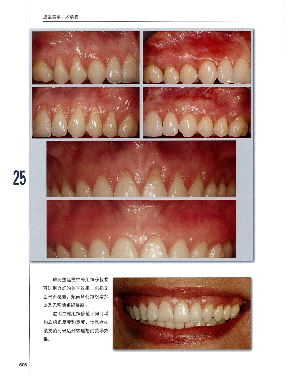 184膜龈美学手术精要_621-640.pdf_第3页