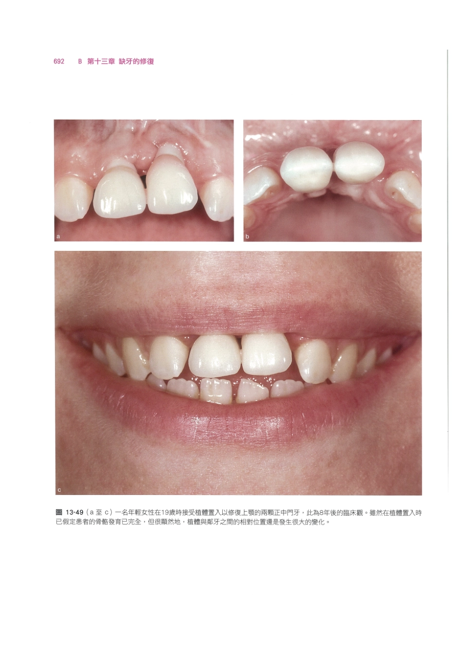 179.牙周整形美容与种植手术_705-712.pdf_第2页