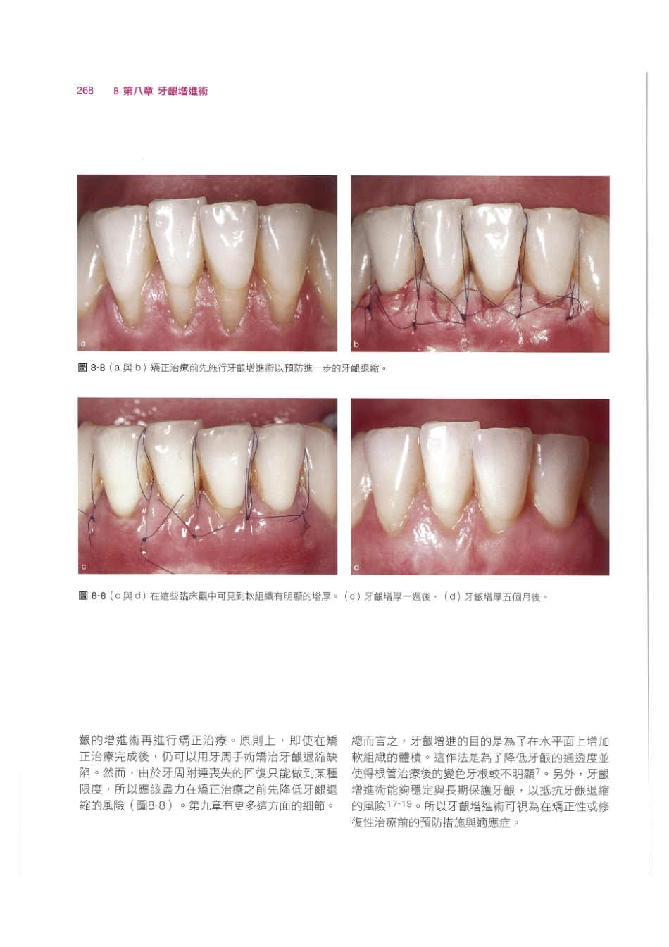 179.牙周整形美容与种植手术_281-288.pdf_第2页