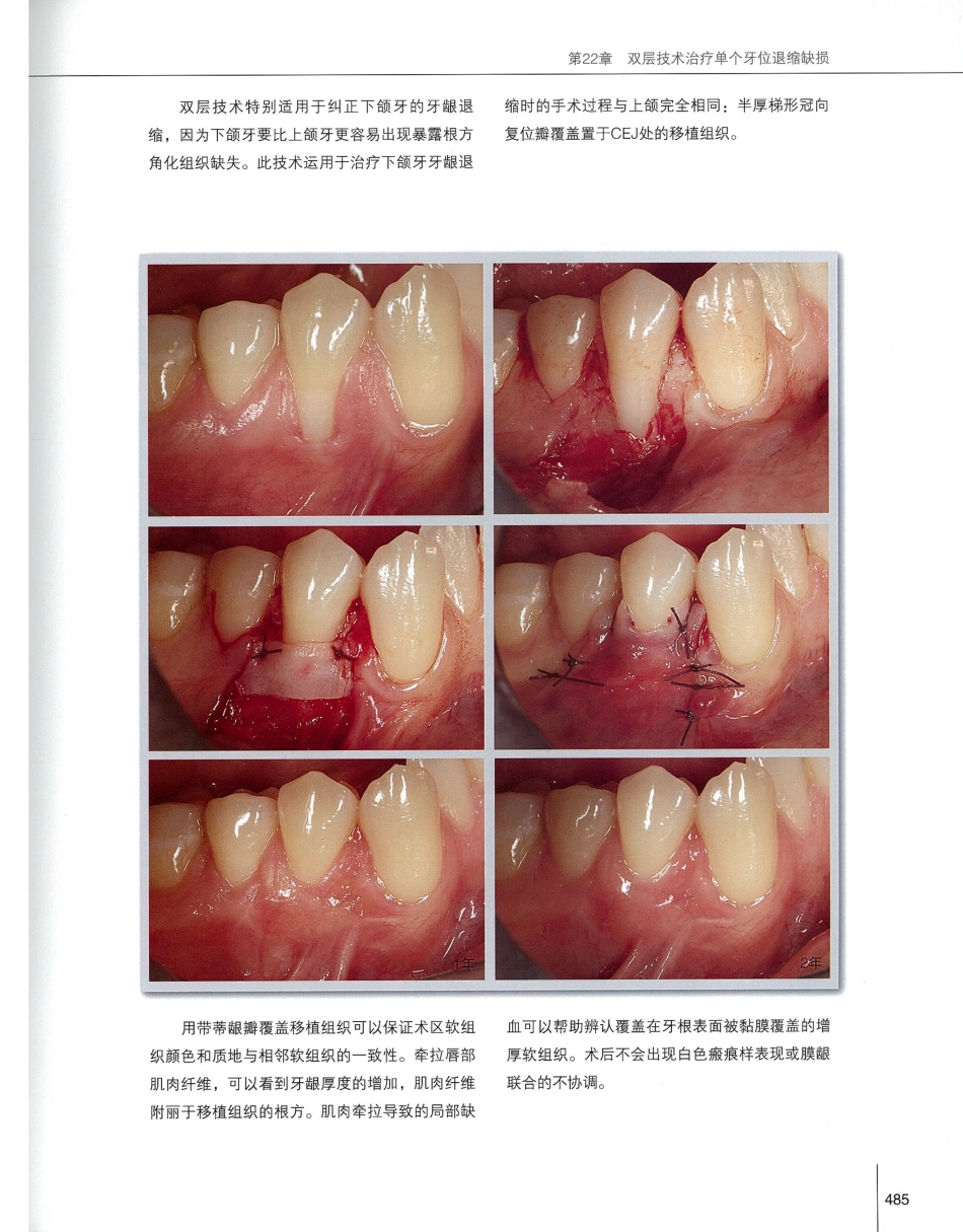 184膜龈美学手术精要_501-520.pdf_第2页