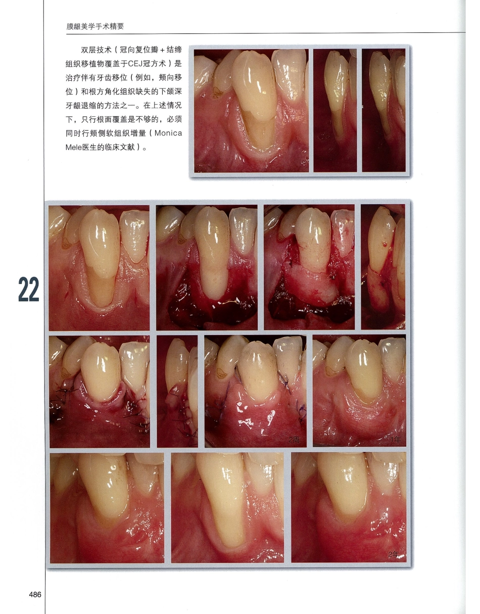 184膜龈美学手术精要_501-520.pdf_第3页