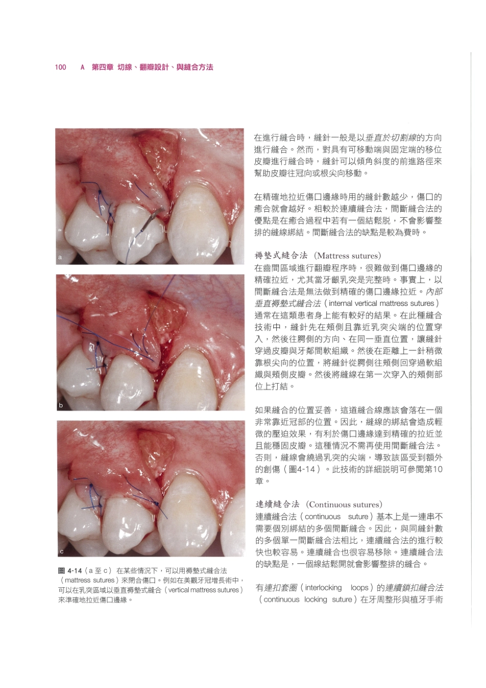 179.牙周整形美容与种植手术_113-120.pdf_第2页