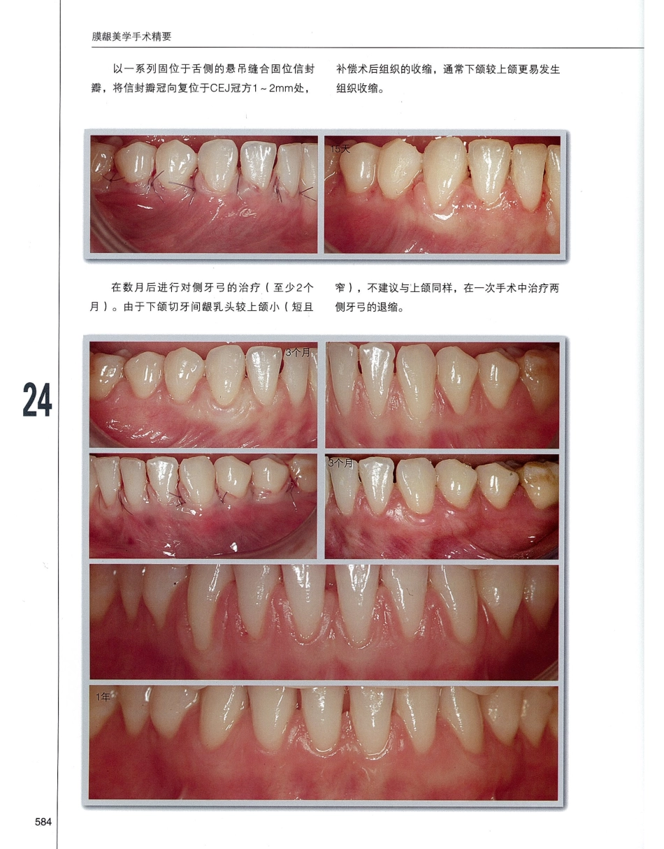 184膜龈美学手术精要_601-620.pdf_第1页