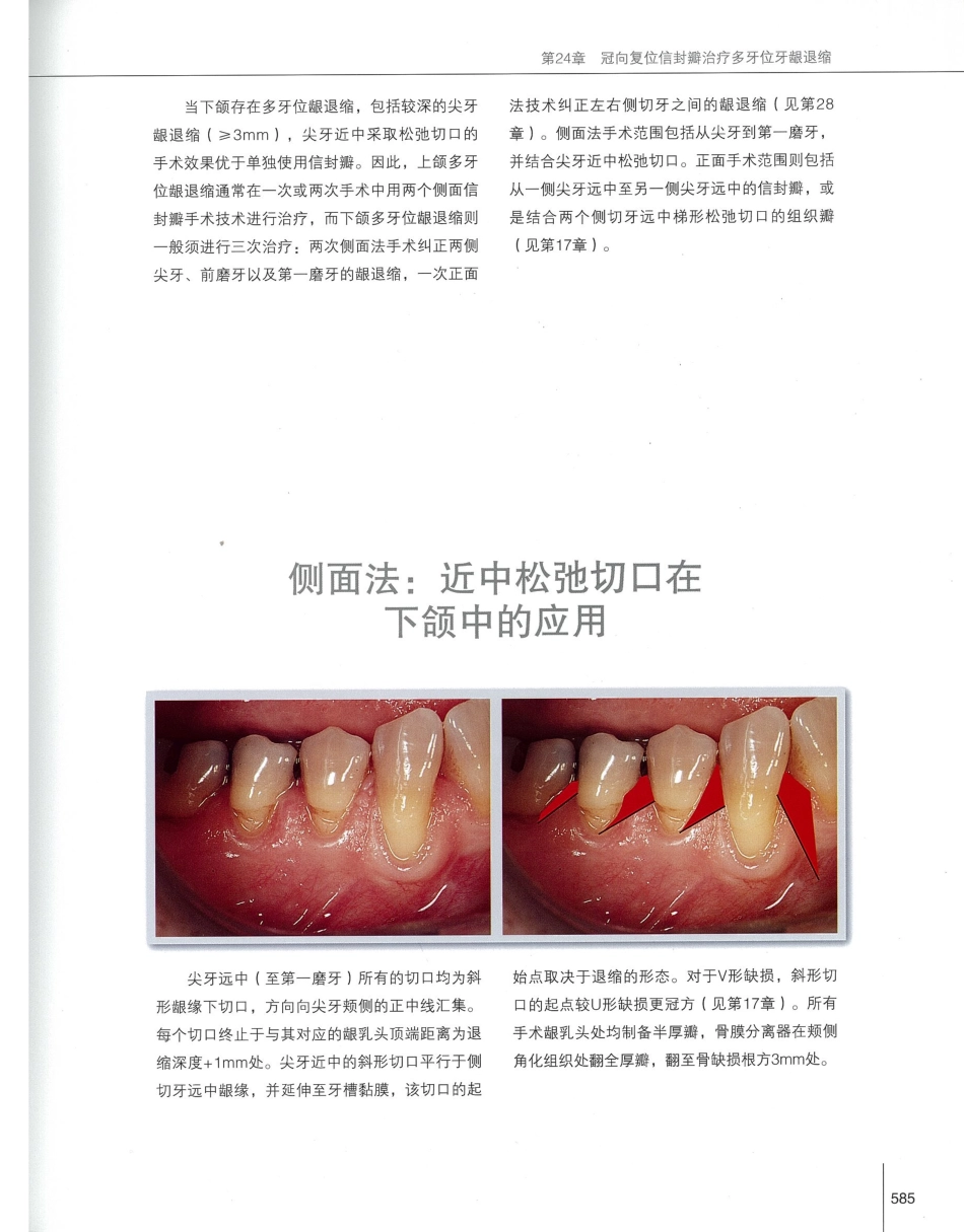 184膜龈美学手术精要_601-620.pdf_第2页