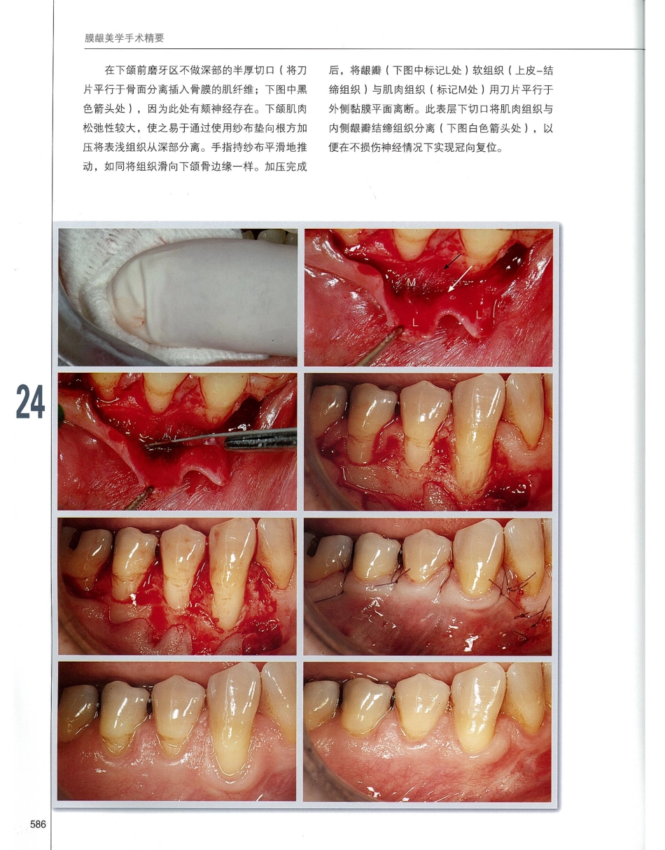 184膜龈美学手术精要_601-620.pdf_第3页