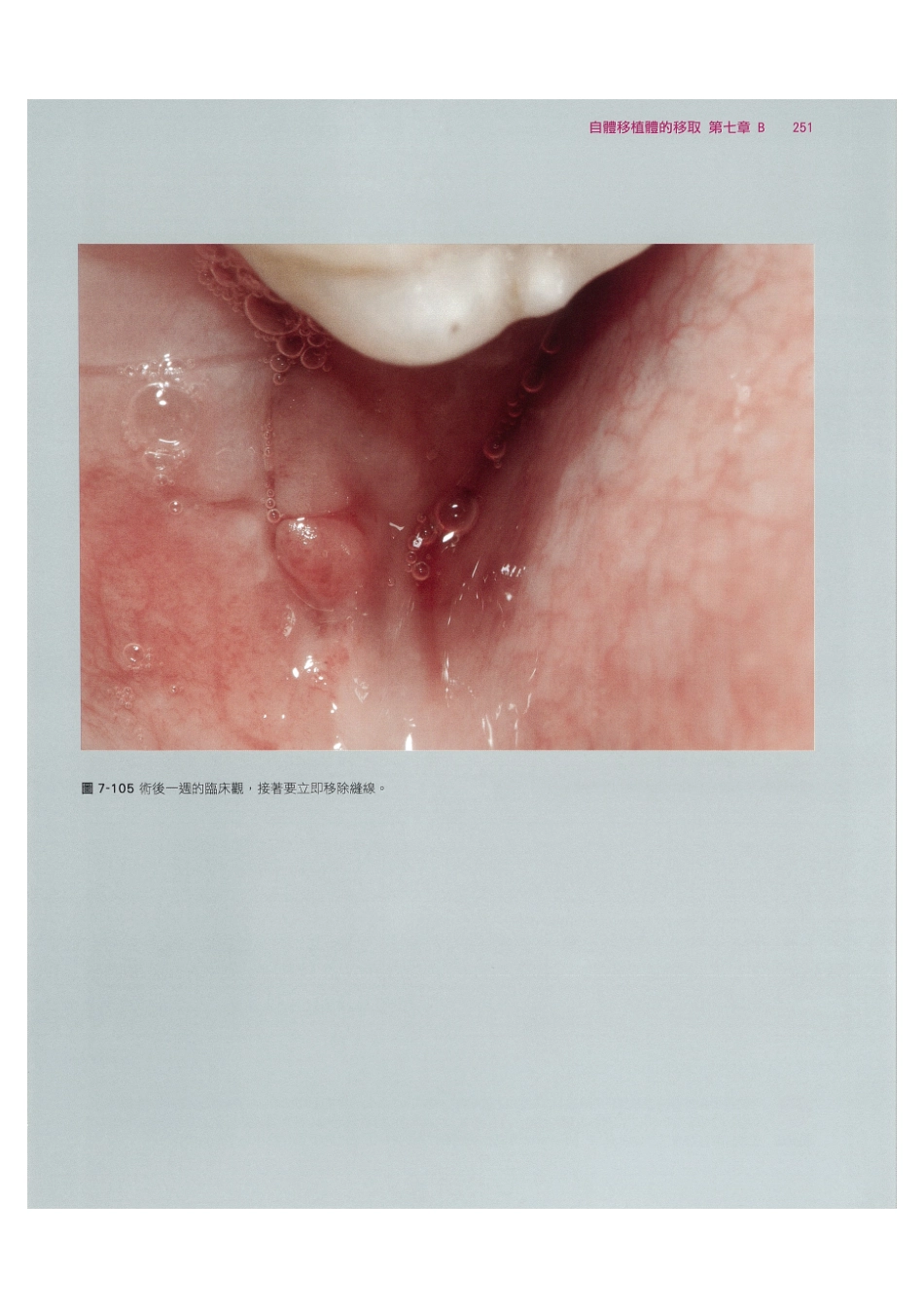 179.牙周整形美容与种植手术_265-272.pdf_第1页