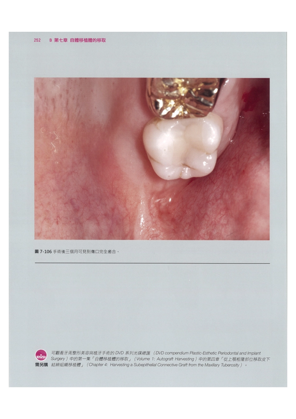 179.牙周整形美容与种植手术_265-272.pdf_第2页