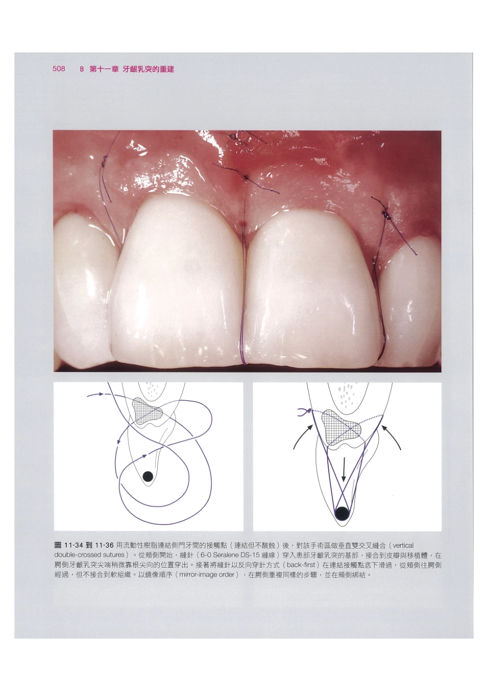 179.牙周整形美容与种植手术_521-528.pdf_第2页