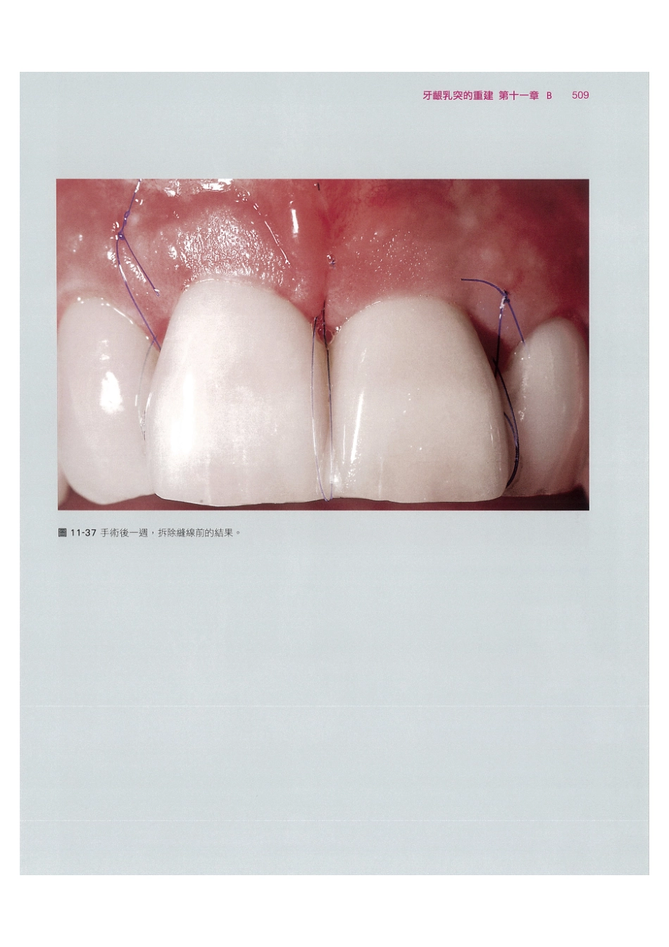 179.牙周整形美容与种植手术_521-528.pdf_第3页