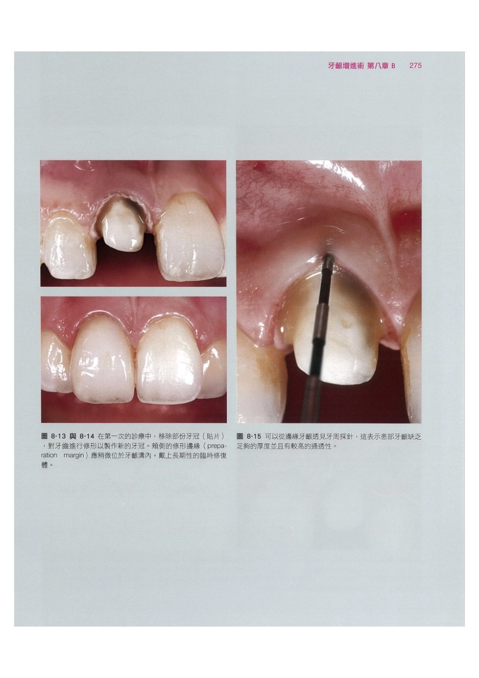 179.牙周整形美容与种植手术_289-296.pdf_第1页