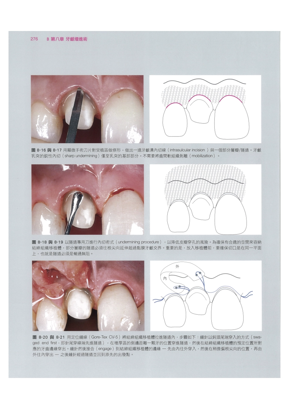 179.牙周整形美容与种植手术_289-296.pdf_第2页