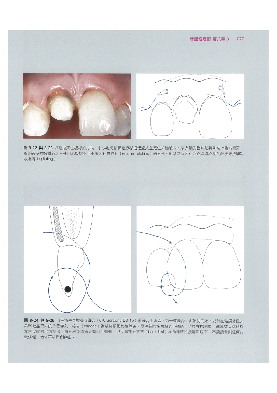 179.牙周整形美容与种植手术_289-296.pdf_第3页