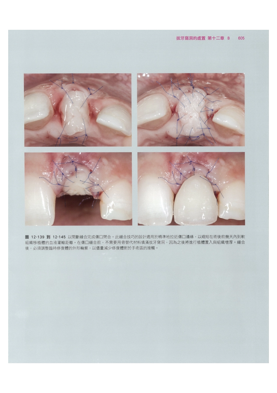 179.牙周整形美容与种植手术_617-624.pdf_第3页